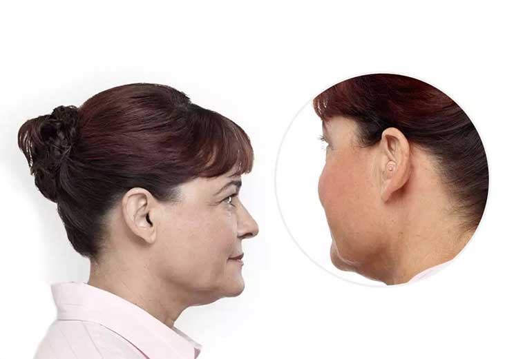 Image show how in-the-ear hearing aid look on a woman
