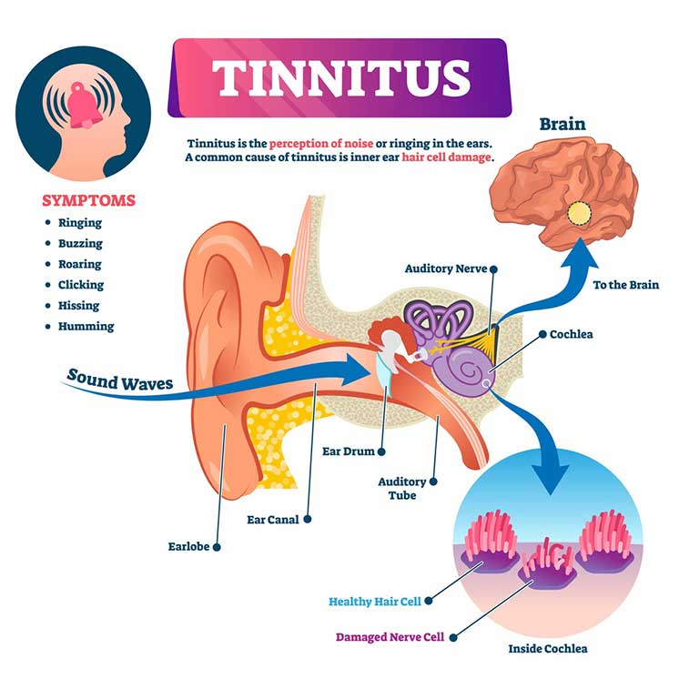 Image show illustration What causes tinnitus