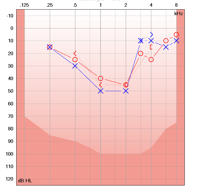 What Does An Audiogram Mean? | What Is An Audiogram?