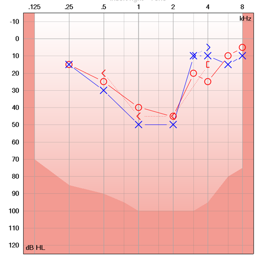 audiogram showing a cookie bite, or mid-frequency loss