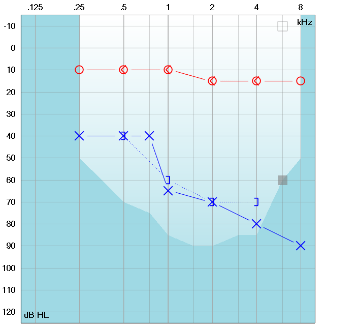 What Does An Audiogram Mean? | What Is An Audiogram?