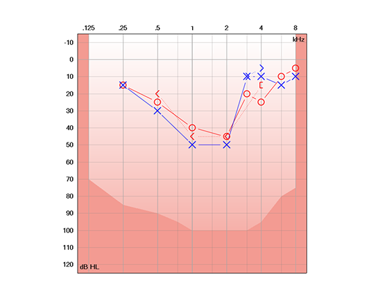 cookie bite audiogram